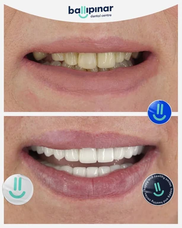 Before and after: worn and discoloured upper front teeth, then a restored upper arch