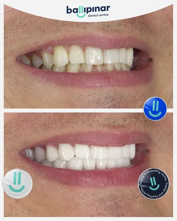 Before and after: uneven upper front teeth, then a more even upper arch