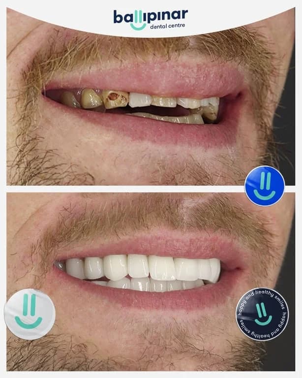 Before and after: heavily damaged and decayed upper teeth, then a restored upper arch