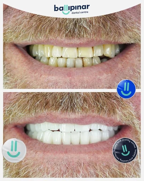 Before and after: worn, discoloured and uneven upper teeth, then a restored upper arch