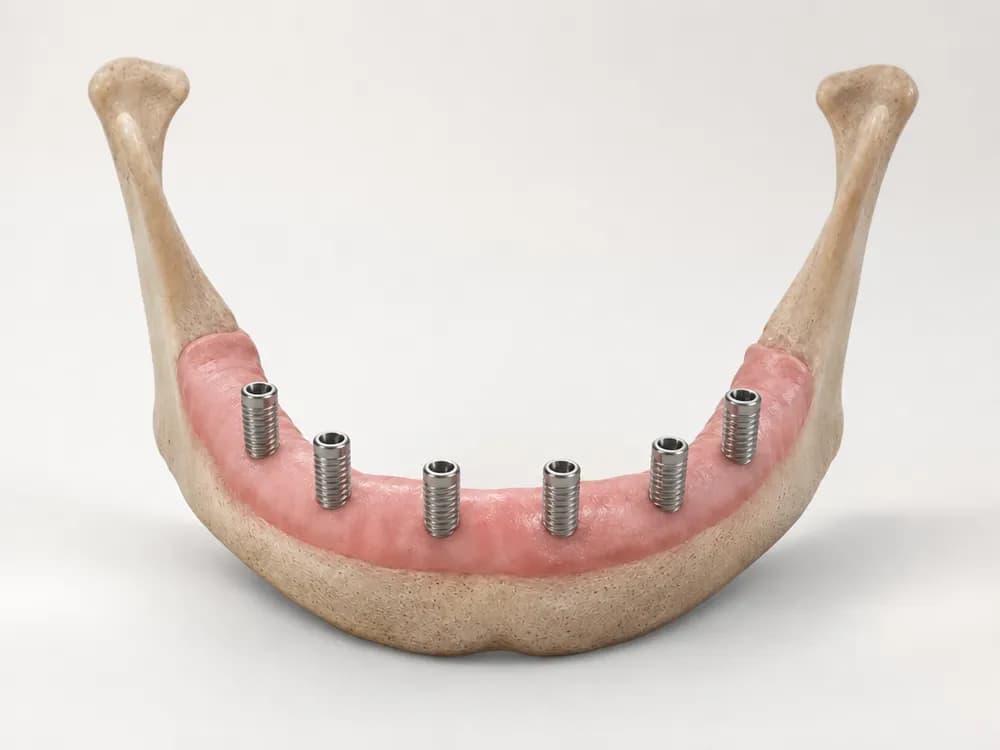 The same jawbone with six implants placed evenly across the arch
