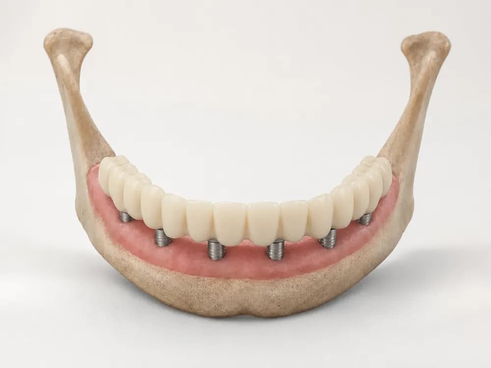 A fixed temporary full-arch bridge seated on the six implants