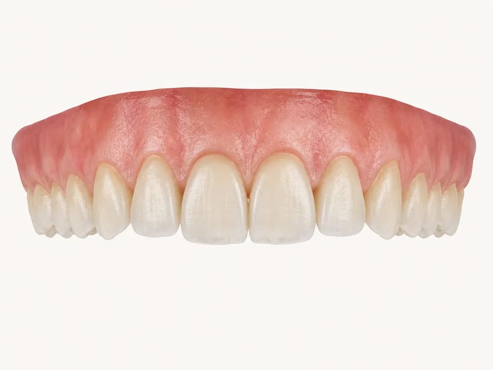 Model of an upper dental arch with natural, slightly irregular teeth