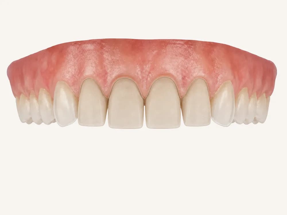 The same arch with the front teeth lightly prepared for veneers