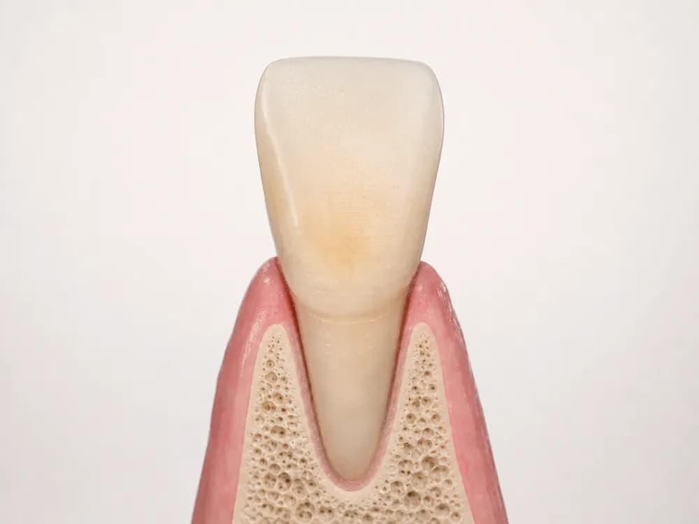 The same tooth with a very thin layer removed from its front surface only