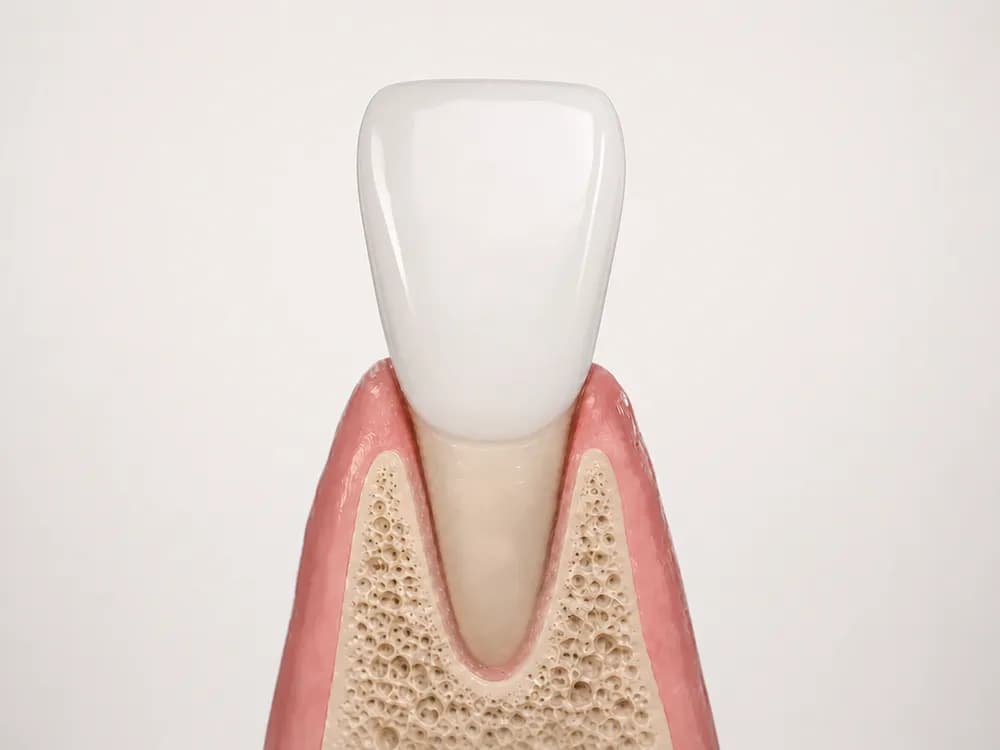 The finished veneer bonded onto the tooth with no visible join at the gum line