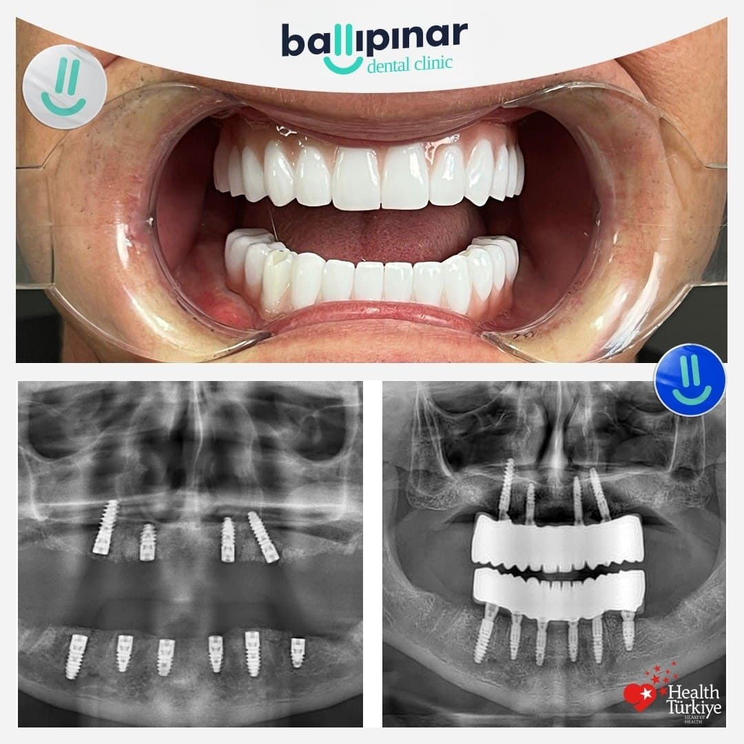 Before and after: missing and failing upper teeth, then a complete fixed upper arch, with matching before/after panoramic X-rays showing four implants placed