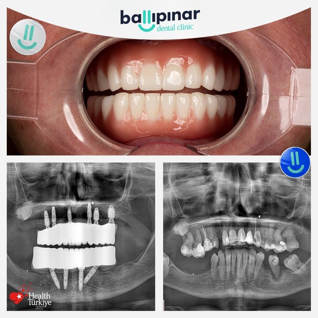Before and after: missing and failing upper teeth, then a complete fixed upper arch, with matching before/after panoramic X-rays showing four implants placed