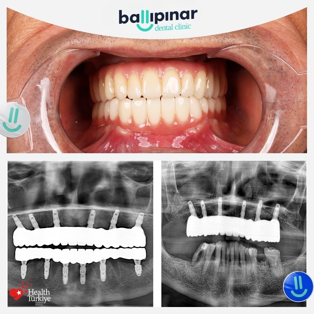 Before and after: missing and failing upper teeth, then a complete fixed upper arch, with matching before/after panoramic X-rays showing six implants placed