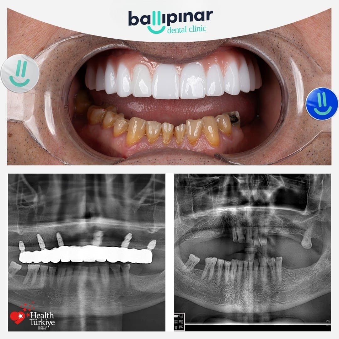 Before and after: missing and failing upper teeth, then a complete fixed upper arch, with matching before/after panoramic X-rays showing six implants placed