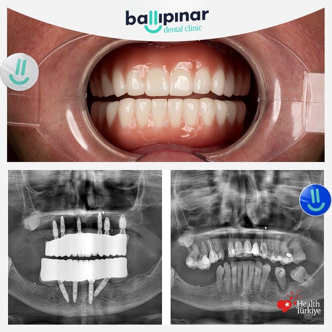 Before and after: missing and failing upper teeth, then a complete fixed upper arch, with matching before/after panoramic X-rays showing six implants placed