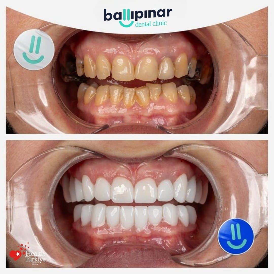 Before and after: heavily discoloured and decayed front teeth, then an even restored arch