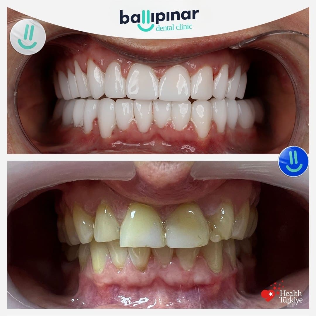 Before and after: discoloured, worn front teeth, then an even restored arch