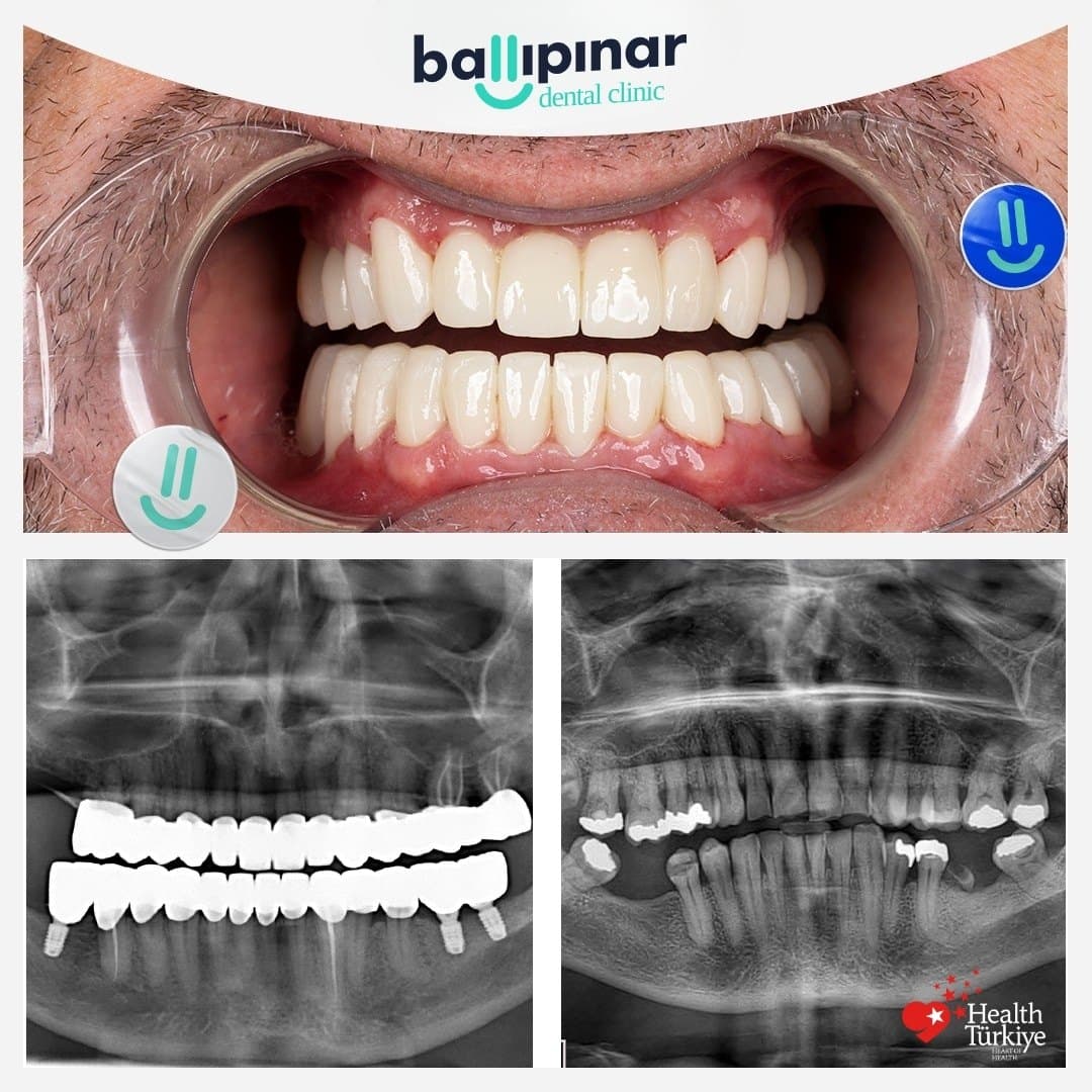 Before and after: discoloured, unevenly worn front teeth, then an even restored arch, with matching before/after panoramic X-rays showing an implant placed