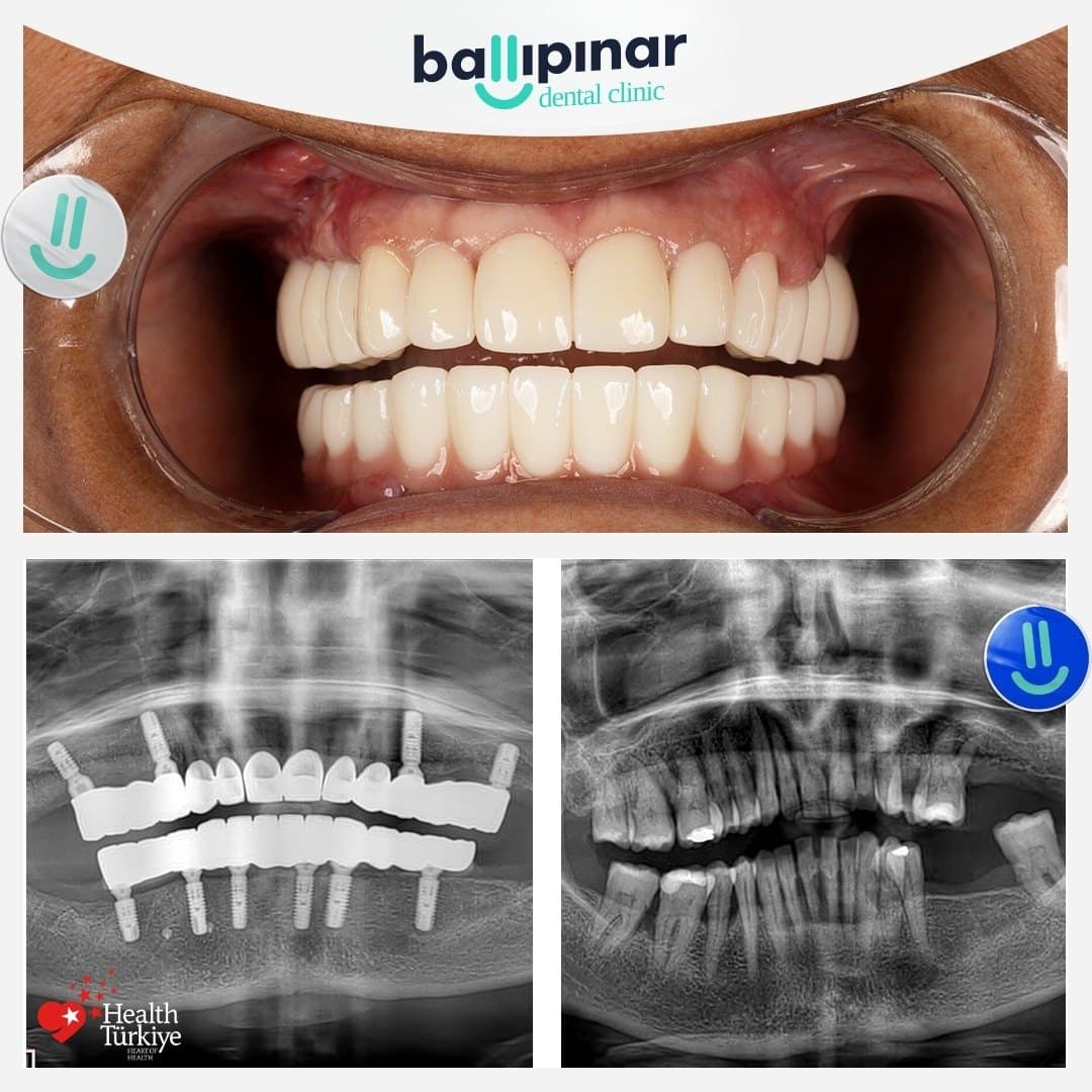 Before and after: gapped, discoloured front teeth, then a complete even arch, with matching before/after panoramic X-rays showing implants placed