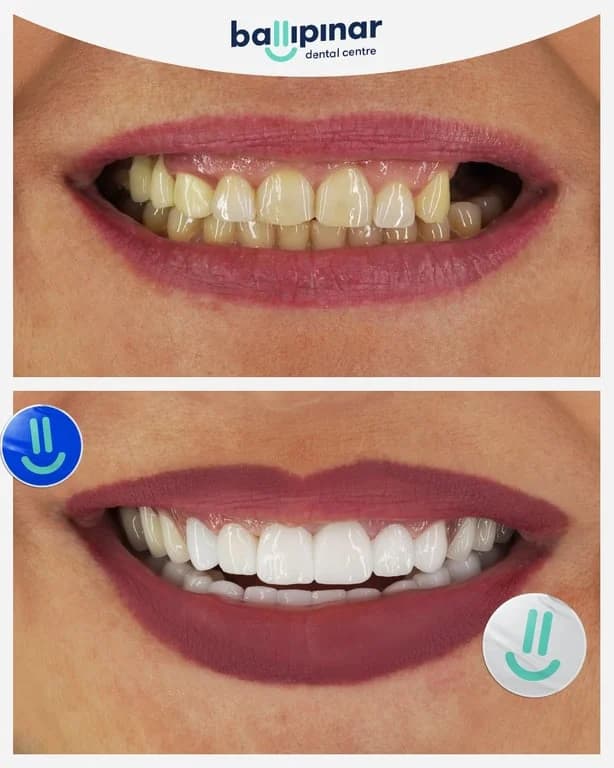 Before and after: upper front teeth with a missing tooth and a dark gap, then a complete even upper arch