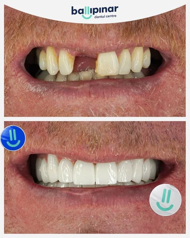 Before and after: several missing upper teeth with wide gaps, then a complete restored upper arch