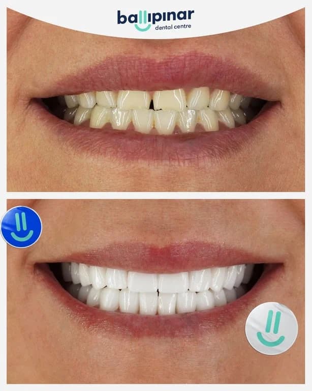 Before and after: chipped and uneven upper front teeth, then an even upper arch