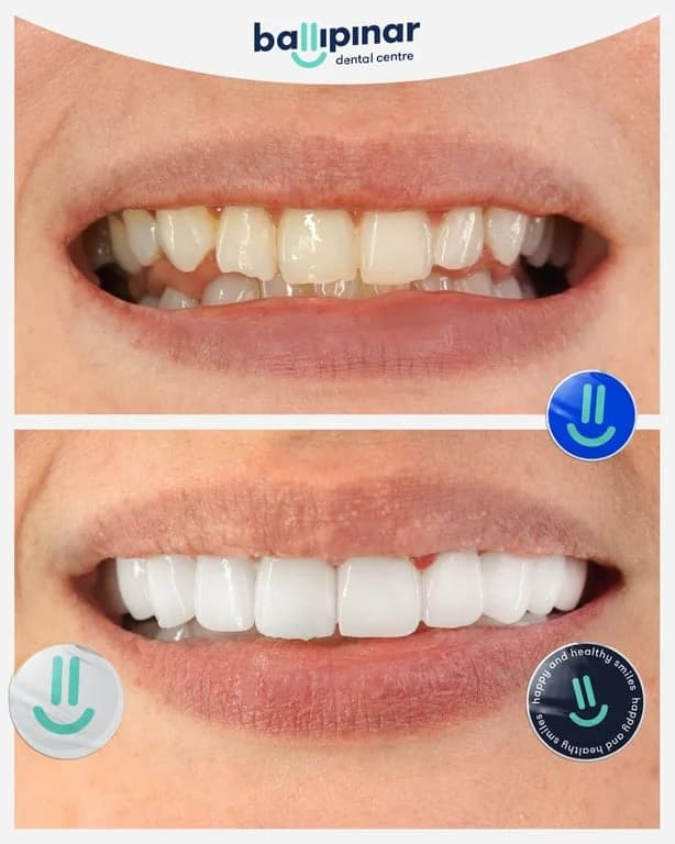 Before and after: crowded and gapped upper front teeth, then an aligned upper arch