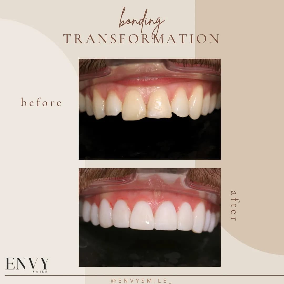 Envy Smile Dental & Aesthetics | Composite Bonding London — photo from their Google listing
